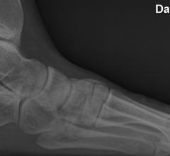 interventional radiology, chronic plantar fasciitis, society, SIR, Rahul Razdan