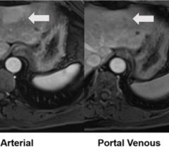 54-year-old with pathologically confirmed inflammatory adenoma in left lobe that underwent evaluation by gadoxetate disodium-enhanced MRI. Axial T1-weighted fat-saturated precontrast image shows isointensity to liver of adenoma (arrow). Axial arterial-phase postcontrast image shows hyperintensity to liver (arrow). Axial portal-venous phase postcontrast image shows hyperintensity to liver (arrow). Axial hepatobiliary-phase postcontrast image shows hyperintensity to liver (arrow). Hepatobiliary-phase liver-to