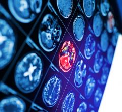 Breast cancer patients whose disease has spread to their brains fare better if their metastases are picked up before they begin to cause symptoms, according to a study presented at the 12th European Breast Cancer Conference.