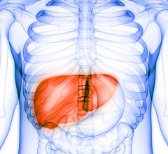 Primary liver cancer is on the rise worldwide, largely due to an increase in hepatitis C infections and chronic liver disease