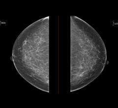 Onsite Women’s Health, Whiterabbit and Washington University in St. Louis Join Forces to Explore Breast Density and Implications for Breast Cancer Risk 