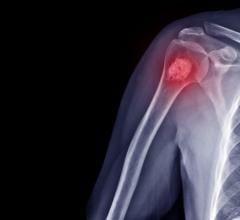 Benign bone tumors may be present in nearly 20 percent of healthy children, based on a review of historical radiographs in The Journal of Bone & Joint Surgery. The journal is published in the Lippincott portfolio in partnership with Wolters Kluwer.