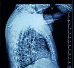 Despite receiving high radiation doses to their tumors, lung cancer patients treated with technique that spares a large part of the esophagus did not develop severe inflammation of the esophagus
