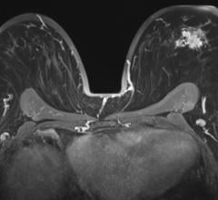 Breast MRI with a tumoral lession in the left breast, axial view. 