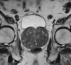 Benign Prostatic Hyperplasia (BPH) or prostate adenoma seen on MRI examination
