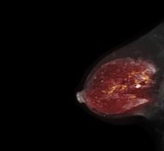 A new paper in the Journal of the National Cancer Institute, published by Oxford University Press, indicates that magnetic resonance imaging (MRI) is cost-effective for detecting breast cancer for women with very dense breasts detected by mammography.