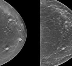 The Radiological Society of North America (RSNA) has announced the launch of the RSNA Screening Mammography Breast Cancer Detection AI Challenge. 