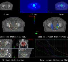 A technique that uses imaging technology as a guide can make radiation therapy safer for patients with prostate cancer by helping clinicians accurately aim radiation beams at the prostate while avoiding nearby tissue in the bladder, urethra, and rectum. 