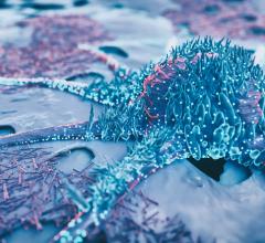 A new study from Keck Medicine of USC finds that the incidence rate of metastatic prostate cancer has significantly increased for men 45 and older and coincides with recommendations against routine prostate cancer screenings.