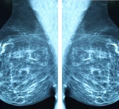 Researchers said women who skip even one scheduled mammography screening before a breast cancer diagnosis face a significantly higher risk of dying from the cancer.