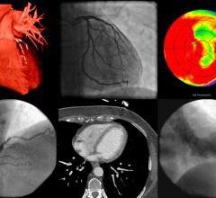 A new study published in Radiology: Cardiothoracic Imaging on cardiac imaging trends over a decade reports that the rate of coronary computed tomography angiography (cCTA) exams by radiologists in hospital outpatient departments increased markedly from 2010 to 2019, suggesting a bright future for the technology.