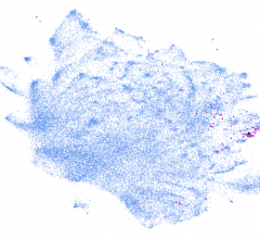 Mount Sinai scientists created an AI-based, automated system that learns to read patient data from electronic health records. Here the system identified dementia cases (purple dots) from a database of nearly 2 million patients (blue dots). Courtesy of the Glicksberg lab, Mount Sinai, N.Y., N.Y.