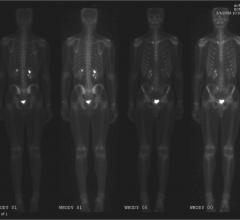 lymphoma, radiation therapy, Red Journal, ASTRO, management