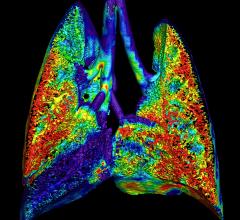 4DMedical, a global technology company and producer of advanced lung function imaging software, has received U.S Food and Drug Administration (FDA) clearance for its CT-based ventilation product (CT LVAS).