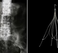 The Society of Interventional Radiology (SIR) published new inferior vena cava (IVC) filter guidelines.