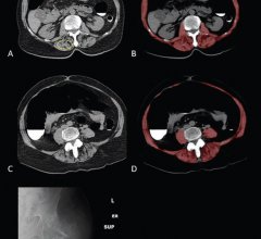 Sarcopenia (Myosteatosis) at Screening CT Colonoscopy in 79-Year-Old Woman With Subsequent Hip Fracture