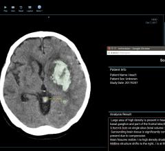 Infervision Launches AI Platform to Help Radiologists Diagnose Stroke Faster