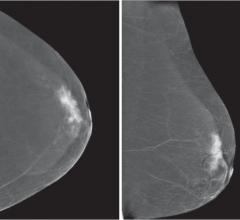 JAMA Article Advocates Making Individualized Choices About Breast Cancer Screening