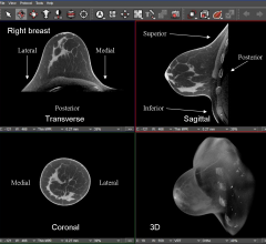 breast density, computed tomography