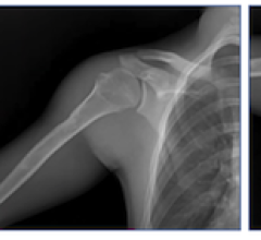 shoulder surgery, Emery, Konica Minolta, digital radiography