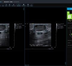 FDA Clears Koios DS Breast 2.0 AI-based Software