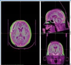  Leksell-GammaPlan-ImageMerge