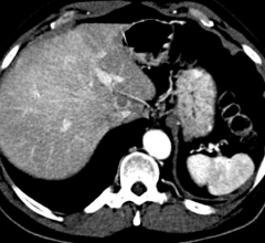 ACR Launches Updated LI-RADS for Liver Imaging