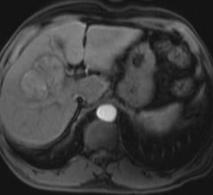Liver cancer tumor scanning using an MRI