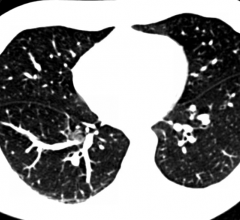 lung cancer recurrence, biomarker blood test, CT scans, 2017 Multidisciplinary Thoracic Cancers Symposium, clinical study