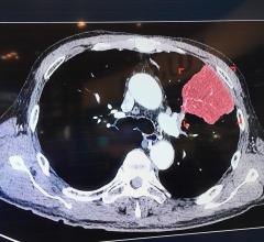 AI Detects Unsuspected Lung Cancer in Radiology Reports, Augments Clinical Follow-up