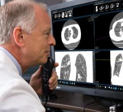 lung cancer, CT, computed tomography, COPD, Screening Protocol Challenge