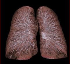 Men Need More Frequent Lung Cancer Screening Than Women