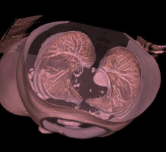Automatic Deformable Alignment Significantly Reduces Radiologist Time to Match Lung Nodule Locations