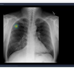 AI Biomarker Demonstrates High Predictive Power for Lung Cancer Immunotherapy