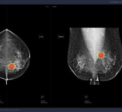 Lunit Showcases AI Solution for Breast Cancer at SBI 2019