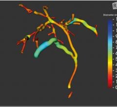 FDA Clears Perspectum's MRCP+ Digital Biliary Tree Viewer
