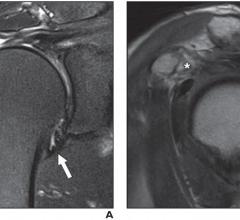 Two magnetic resonance imaging (MRI) findings — joint capsule edema and thickness at the axillary recess, specifically — proved useful in predicting stiff shoulder in patients with rotator cuff tears, according to an ahead-of-print article in the May issue of the American Journal of Roentgenology (AJR)