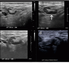 (A) A 46-year-old patient with a strong family history of breast cancer had a screening ultrasound prior to COVID-19 vaccination demonstrating a morphologically normal left axillary lymph node. (B) 25 days following the second dose of the COVID-19 vaccination, the patient presented with a palpable lump in the left axilla and ultrasound demonstrated enlarged lymph nodes with cortex measuring up to 6 mm in thickness (arrow). (C) A follow-up ultrasound 21 weeks following demonstrated stable axillary lymphadeno