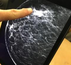 Breast Cancer Follow-up Imaging Varies Widely