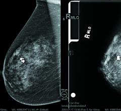 dense breast tissue, dense breast imaging, BIRADS, BI-RADS, mammography grading system, comparison of dense breast tissue, Fibroglandular densities