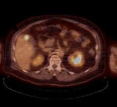 Proton Therapy Radiation X-Ray Liver Metastases