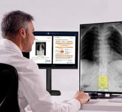 Medimaps Group to Premier AI Software for X-ray Scans at RSNA 2025