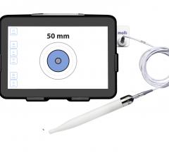 Molli provides breast cancer patients with a better experience over traditional wire and other lesion localization options; the new device helps surgeons remove lesions more efficiently with accuracy and specificity
