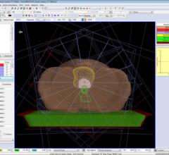 Elekta Launches New Version of Monaco Treatment Planning System with Segment Shape Optimization