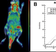 PET Imaging Agent Could Provide Early Diagnosis of Rheumatoid Arthritis
