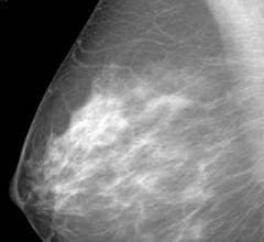 Norwegian Study Confirms Higher Cancer Rate in Women with Dense Breast Tissue