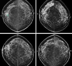 Study Finds Women With High Breast Cancer Risk Declining MRI Screening