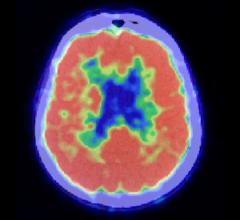 Brain Imaging Study Uncovers Ethnoracial Differences in Dementia 
