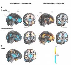 Differences in brain activity between connected and disconnected states of consciousness studied with positron emission tomography (PET) imaging. Activity of the thalamus, anterior (ACC) and posterior cingulate cortices (PCC), and bilateral angular gyri (AG) show the most consistent associa-tions with the state of consciousness (A = general anesthesia, B = sleep). The same brain struc-tures, which are deactivated when the state of consciousness changes to disconnected in general anesthesia or natural sleep 