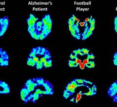 Abnormal Protein Concentrations Found in Brains of Military Personnel With Suspected CTE